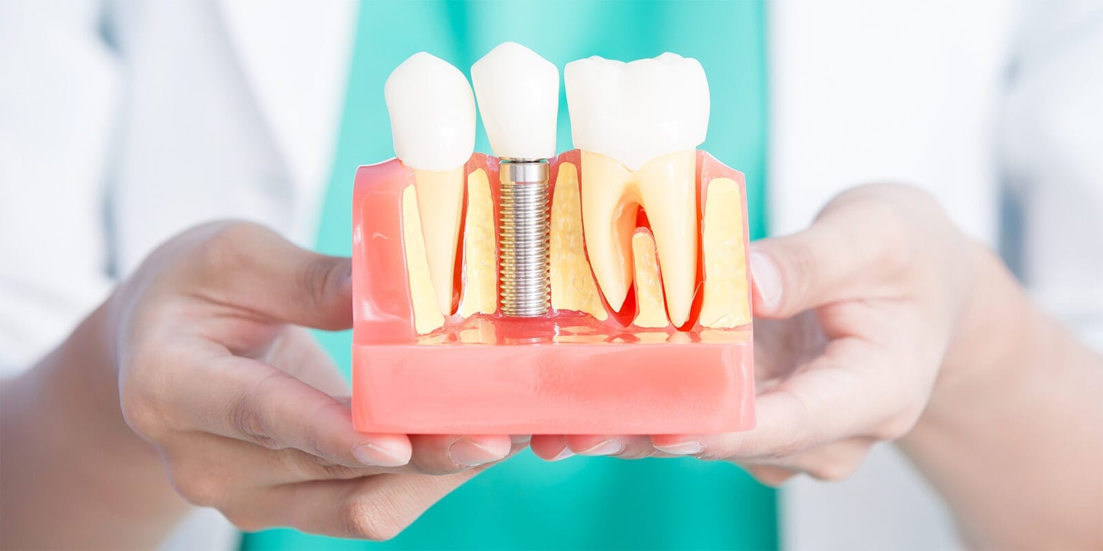 Dental implant - Serdent Eskisehir