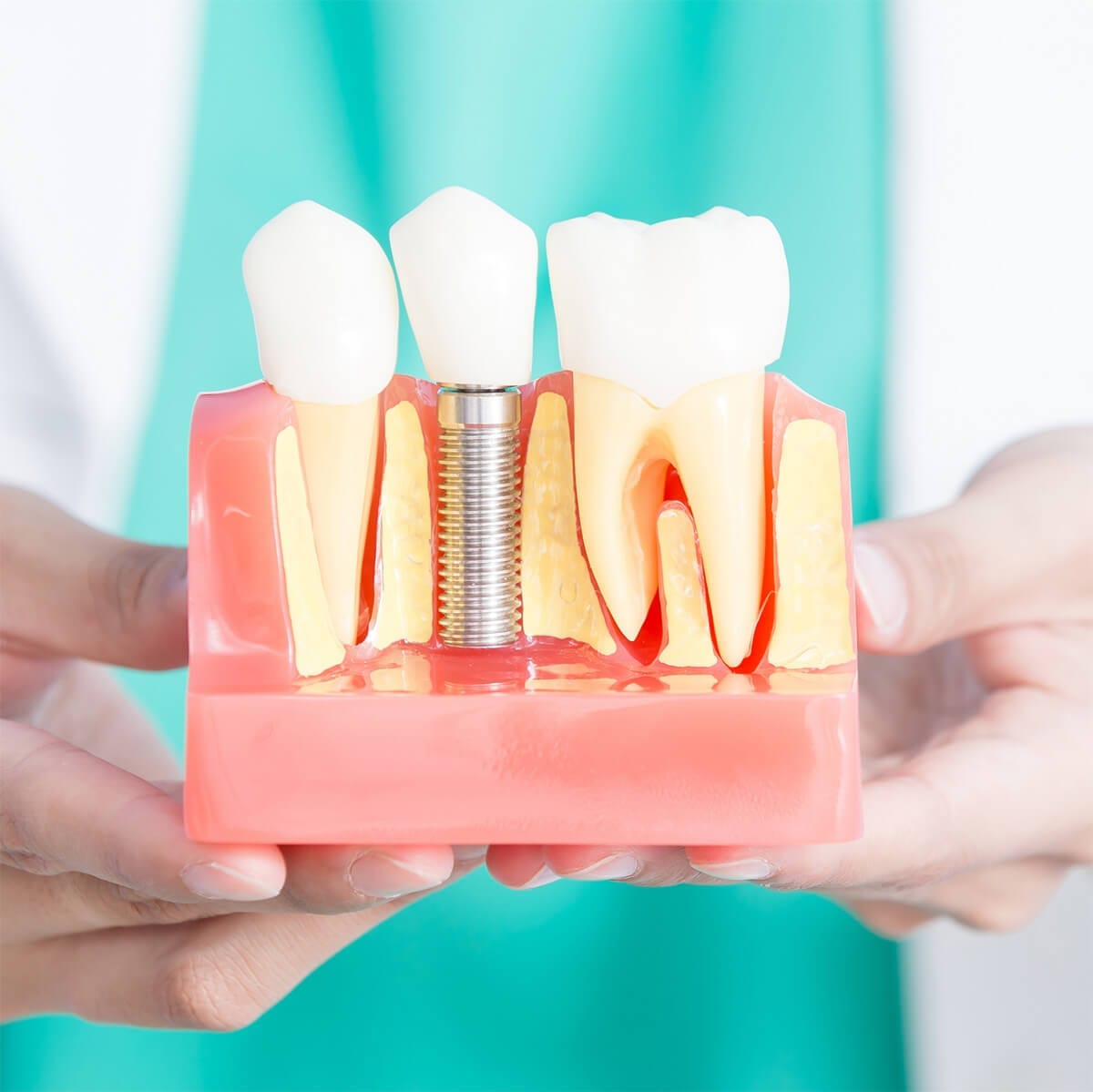 Dental implant treatment - Serdent dental clinic in Eskisehir