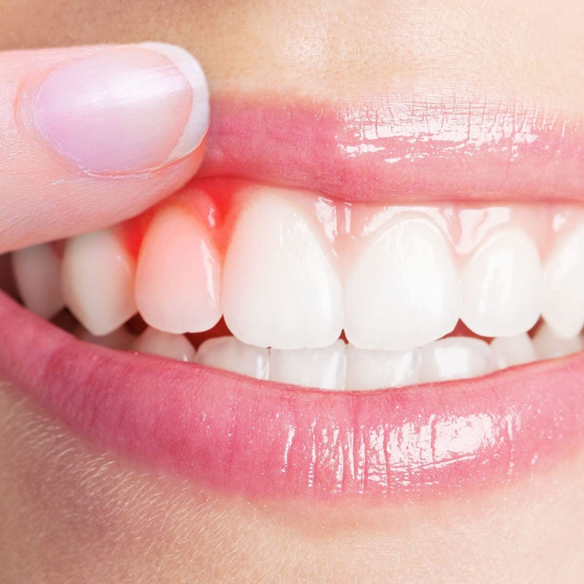 Gum treatment (periodontology) - Serdent dental clinic in Eskisehir