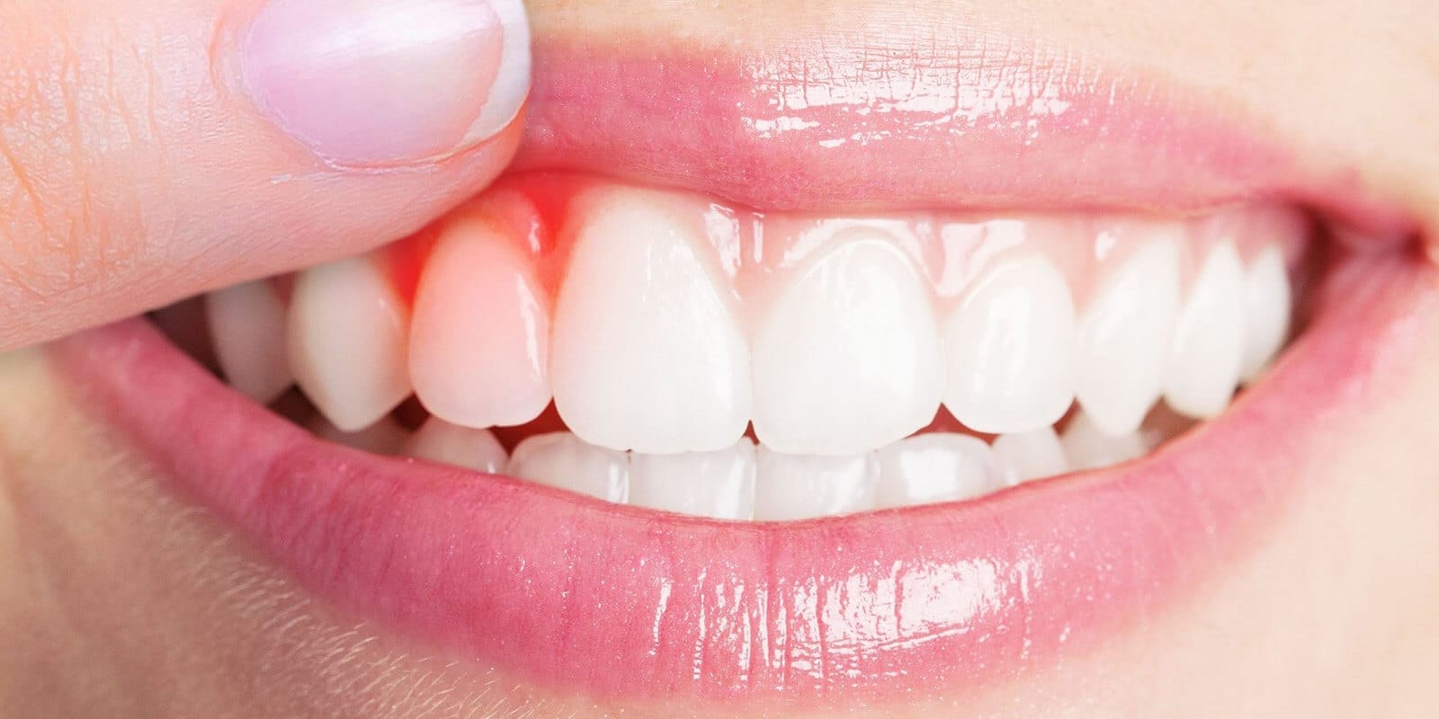 Gum treatment - Serdent Eskisehir