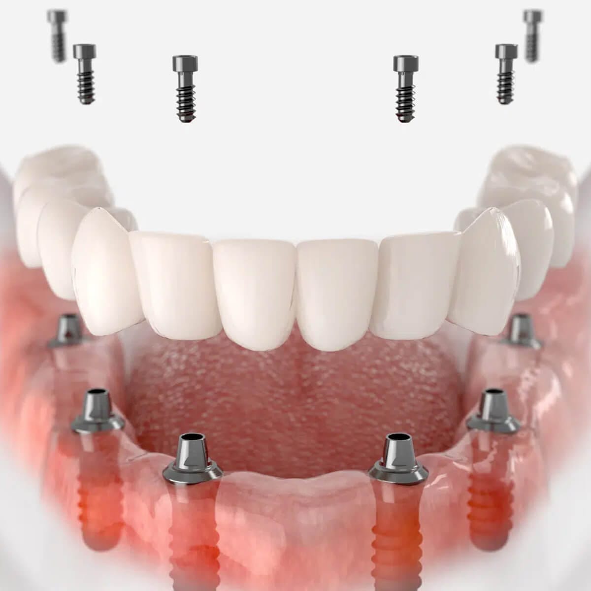 Implant-supported prosthesis - Serdent dental clinic in Eskisehir