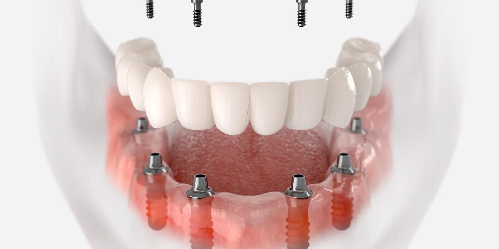 Implant-supported prosthesis - Serdent Eskisehir