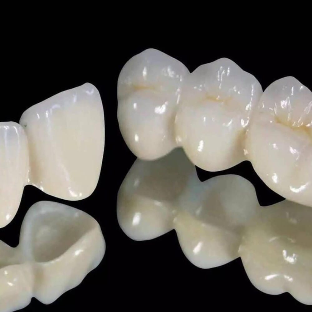 Laminate veneer and zirconia crown restorations