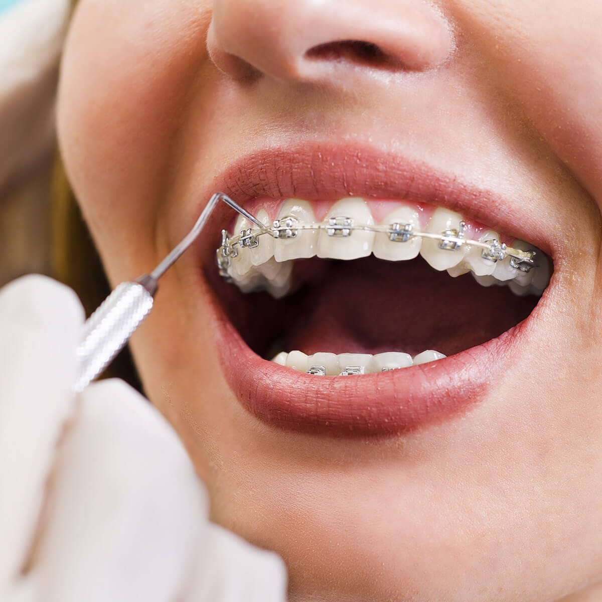 Orthodontic treatment (braces) - Serdent dental clinic in Eskisehir