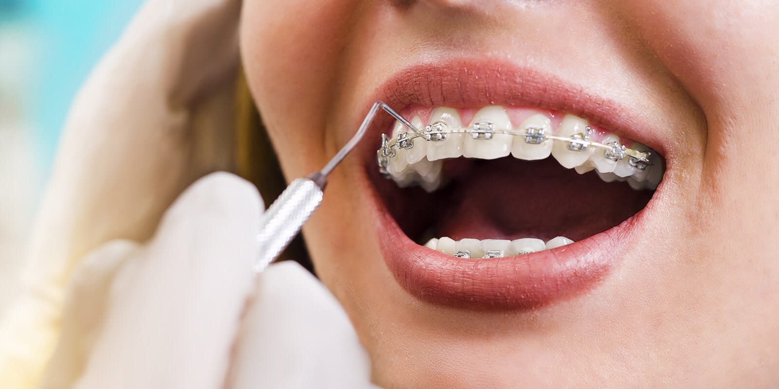 Orthodontic treatment - Serdent Eskisehir