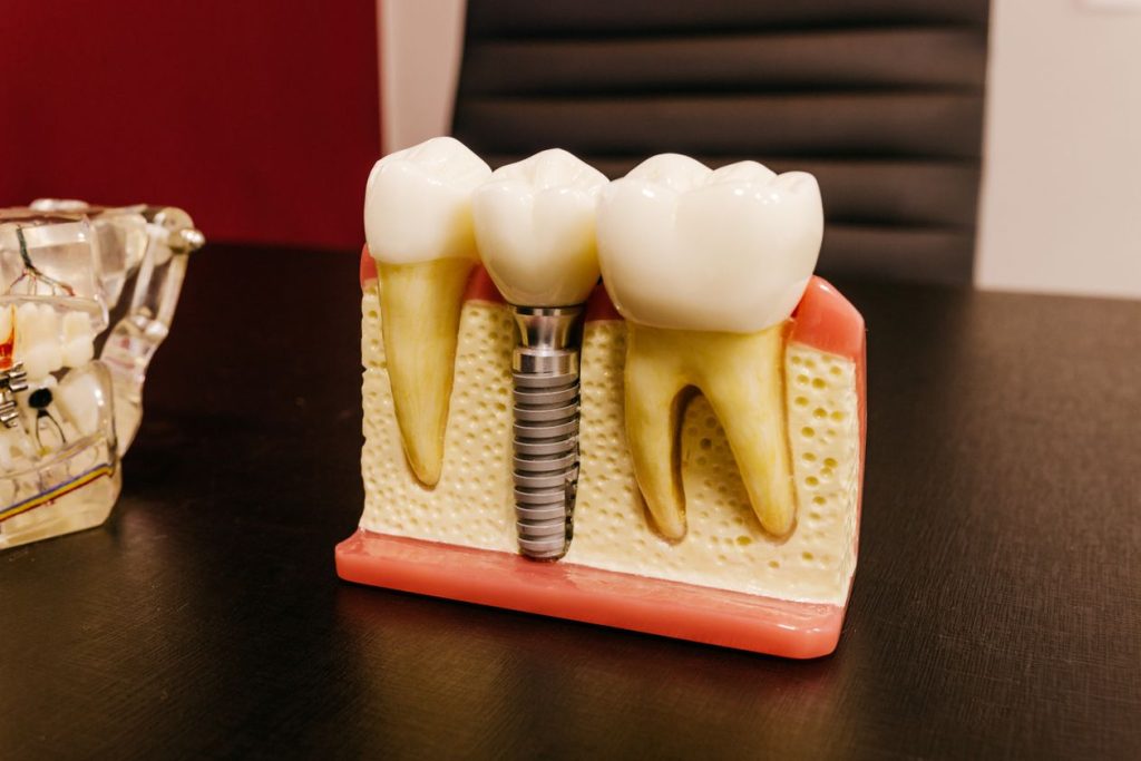 Diş implantı modeli